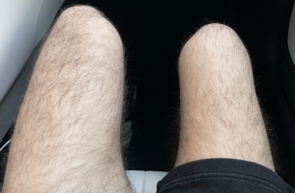 Artur's legs showing the difference in muscle mass after ACL surgery